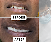 Before and after dental treatment result - unnamed (2).png